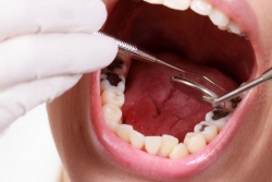 Cách trị sâu răng tại nhà bằng phương pháp dân gian có thật sự hiệu quả hay chỉ nhất thời. Bài viết này Đông y Xuân Vinh sẽ cung cấp cách trị sâu răng...