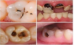 Mọi người ơi! Em đang bầu mà bị sâu răng đau nhức có cách nào trị giảm đau, giảm sâu mà không phải nhổ răng không ạ? Mọi người hoan hỉ chỉ cách giúp...