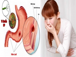 Đau dạ dày cấp và mãn tính, trào ngược dạ dày, viêm loét dạ dày, khuẩn HP..Viêm đại tràng: Đi ngoài phân nát phân sống. Đừng bỏ qua sản phẩm đặc trị...