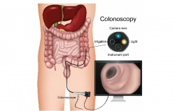 UNG THƯ ĐẠI TRÀNG: NGUYÊN NHÂN, DIỄN TIẾN BỆNH VÀ CÁCH PHÒNG NGỪA HIỆU QUẢ